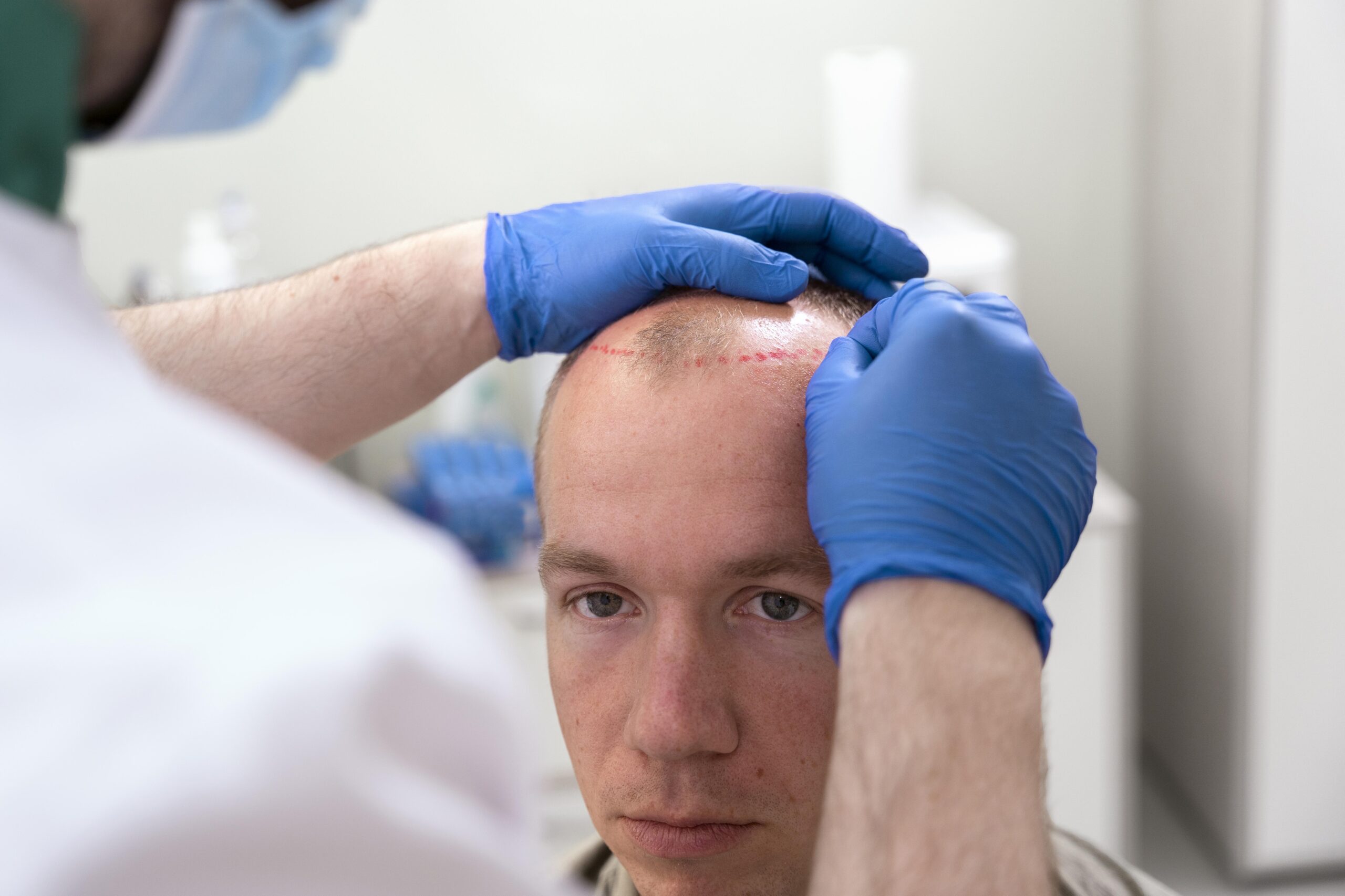 Die beste Haartransplantation in Deutschland