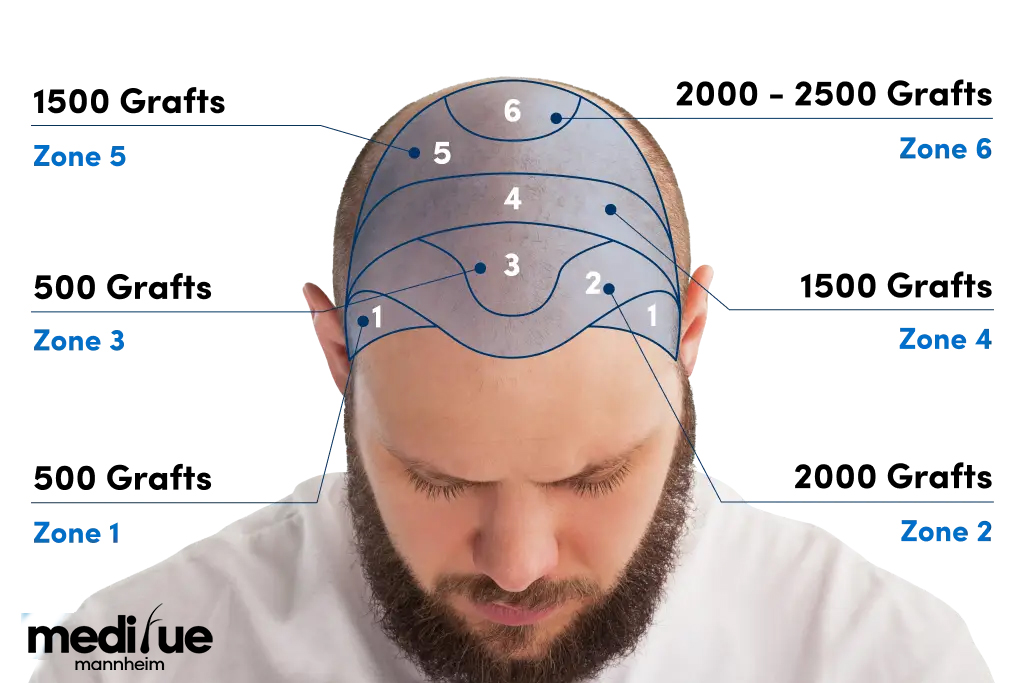 Wie dauerhaft ist eine Haartransplantation?