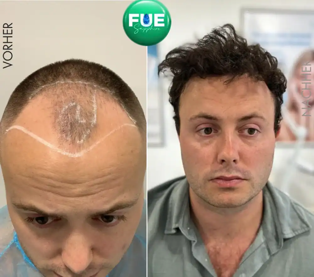 5000 Grafts Haartransplantation Deutschland 2026