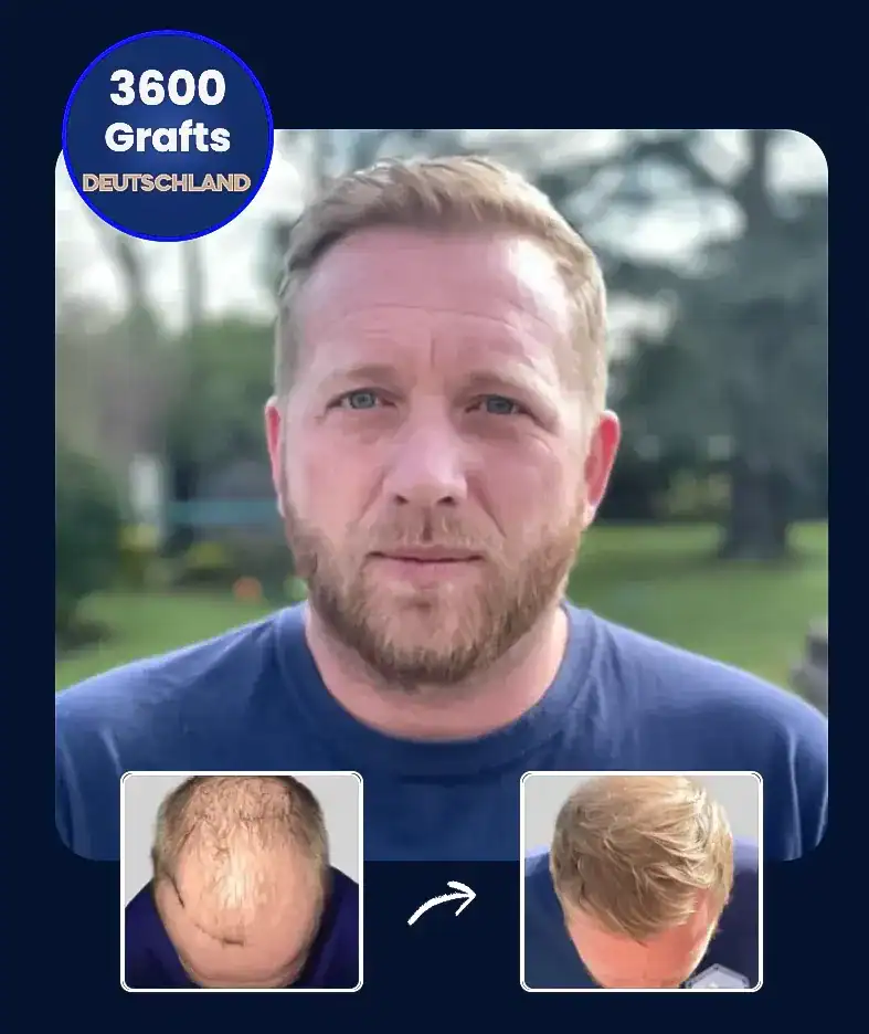 DHI Haartransplantation Ergebnis und Vorher Nachher Bilder – präzise Implantation und dichter Haarwuchs nach 1 Jahr