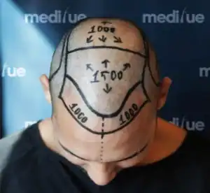 Haartransplantation in Deutschland 2026 – Kostenvergleich und natürliche Ergebnisse bei Medifue.