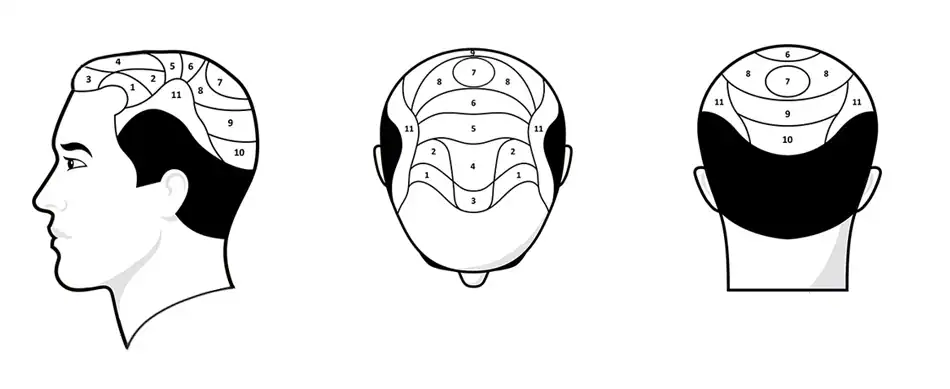 Haartransplantationsbereiche