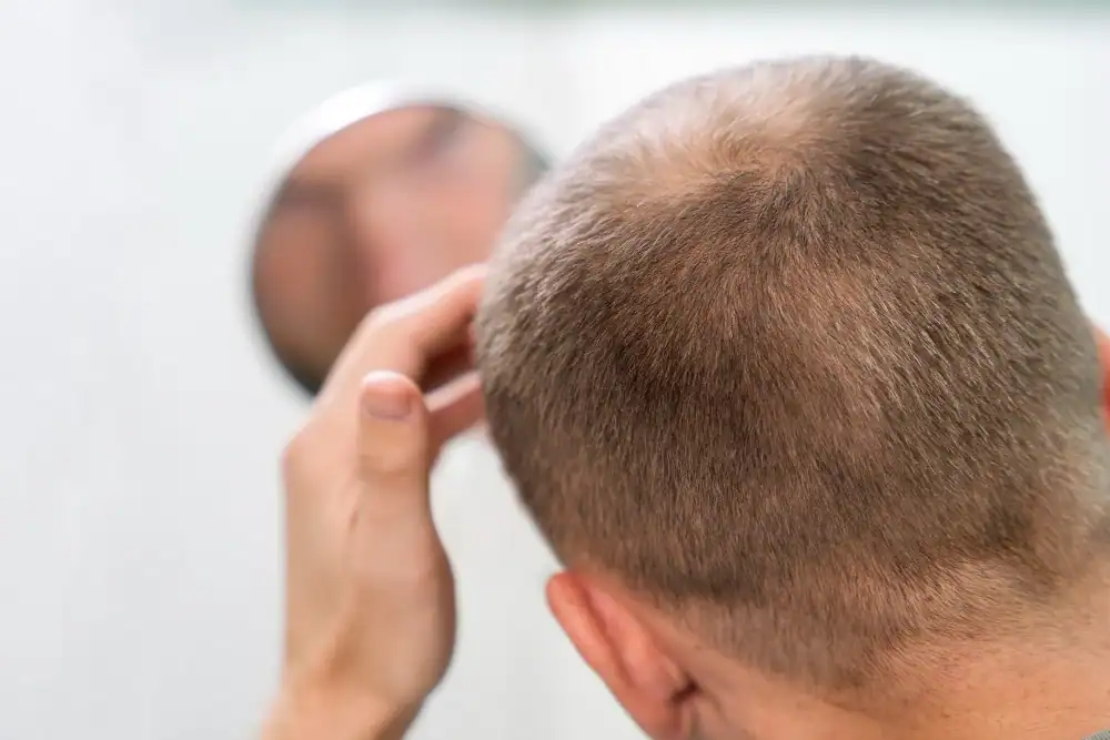 haartransplantation koeln