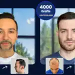 haartransplantation-sapphire-fue-vorher-nachher