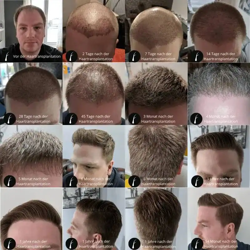 Haartransplantation Verlauf Vorher Nachher – von 2 Tagen bis 1 Jahr nach der OP