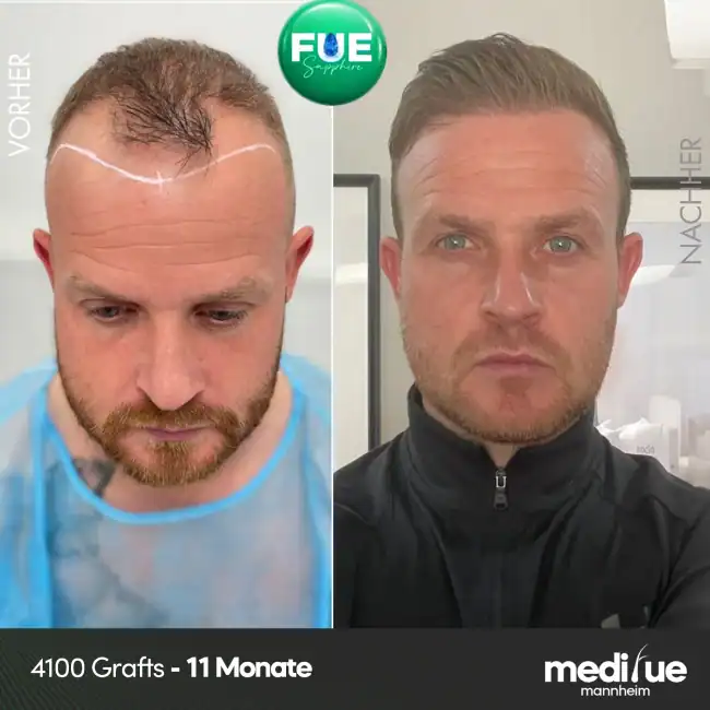 aartransplantation Ergebnis 11 Monate nach der OP, 4100 Grafts