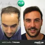 haartransplantation-vorher-nachher-4400-grafts-7-monate