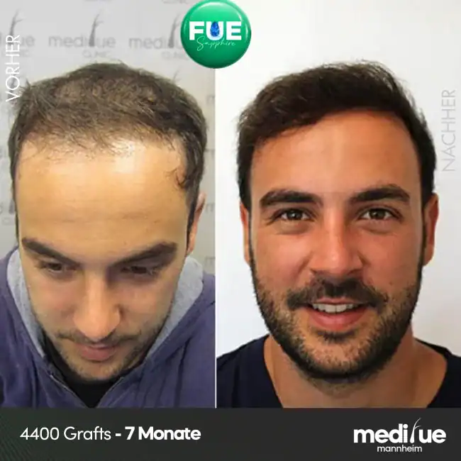FUE Haartransplantation Vorher Nachher, 4400 Grafts Ergebnis nach 7 Monaten