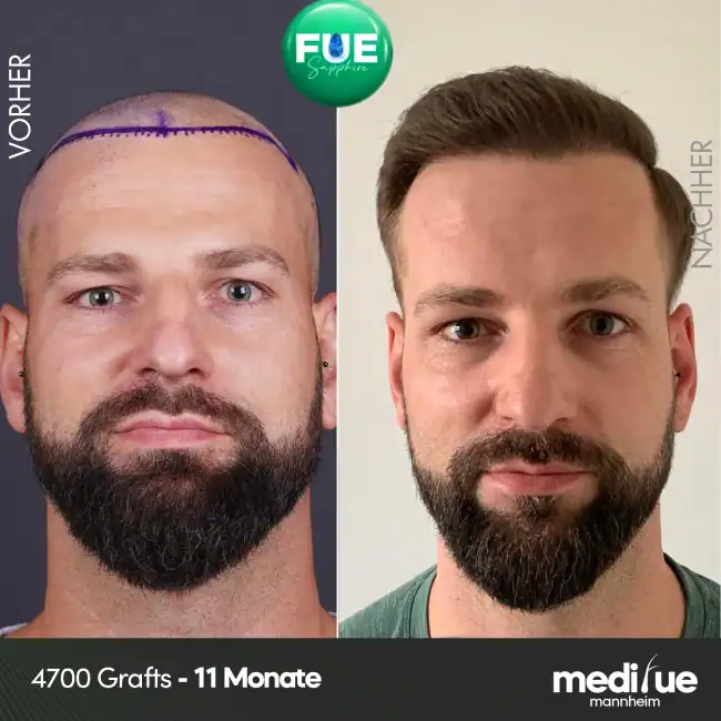 Haartransplantation Vorher Nachher, 4700 Grafts Ergebnis nach 11 Monaten