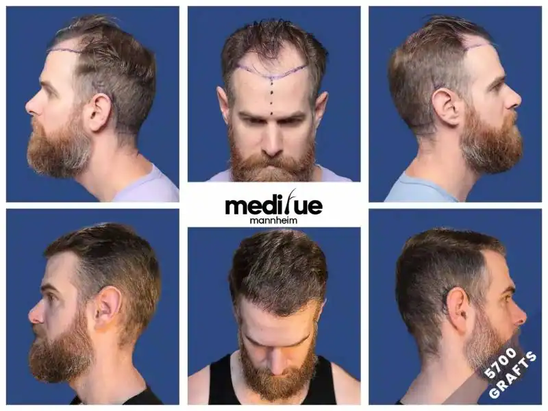 Haartransplantation Vorher Nachher mit 5700 Grafts, Seiten - und Vorderansicht