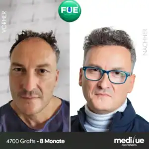 Haartransplantation Vorher Nachher Ergebnisse in Deutschland – natürliche Resultate mit FUE, Sapphire FUE und DHI Methoden von Medifue