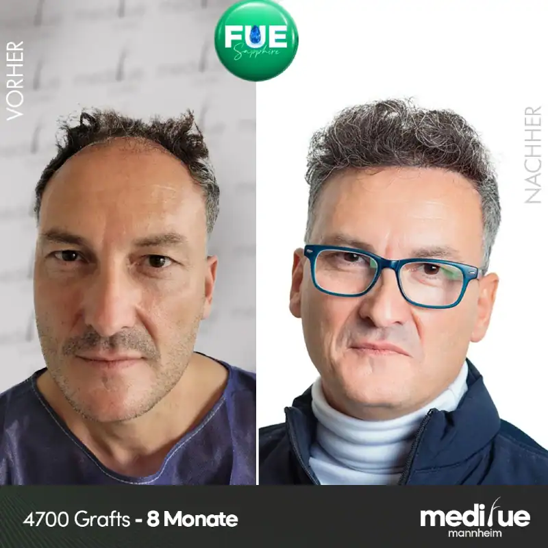 Haartransplantation Vorher Nachher Ergebnisse in Deutschland – natürliche Resultate mit FUE, Sapphire FUE und DHI Methoden von Medifue
