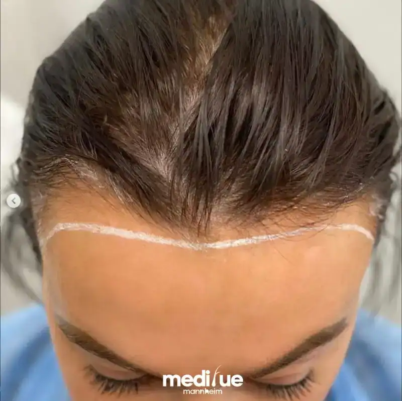 Frauen Haartransplantation in Köln – vorher