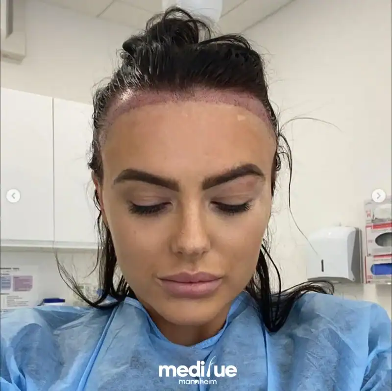 Rasurfreie Haartransplantation bei Frauen – direkt nach dem Eingriff