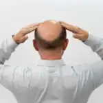 Hamilton-Norwood-Skala: Die 7 Stadien des Haarausfalls einfach erklärt the-norwood-scale-guide